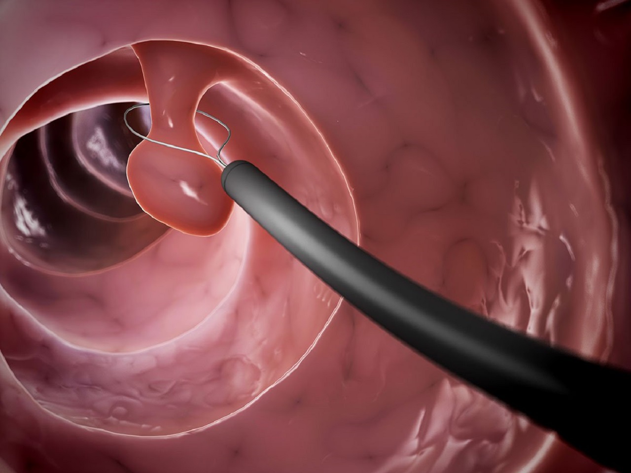 Tìm hiểu về ung thư polyp đại tràng