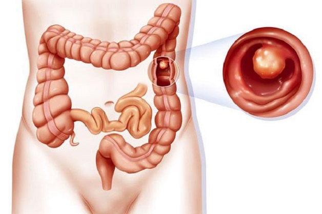 Tìm hiểu về ung thư polyp đại tràng