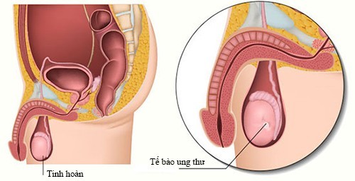 Tìm hiểu về ung thư tinh hoàn phổ biến ở nam giới từ 20 – 35 tuổi