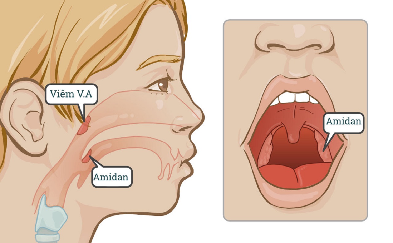 Tìm hiểu về VA quá phát: Biểu hiện và những biến chứng