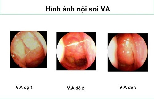 Tìm hiểu về VA quá phát: Biểu hiện và những biến chứng