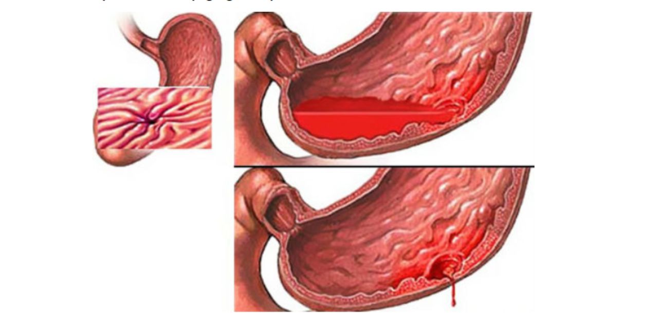 Tìm hiểu về viêm ruột xuất huyết