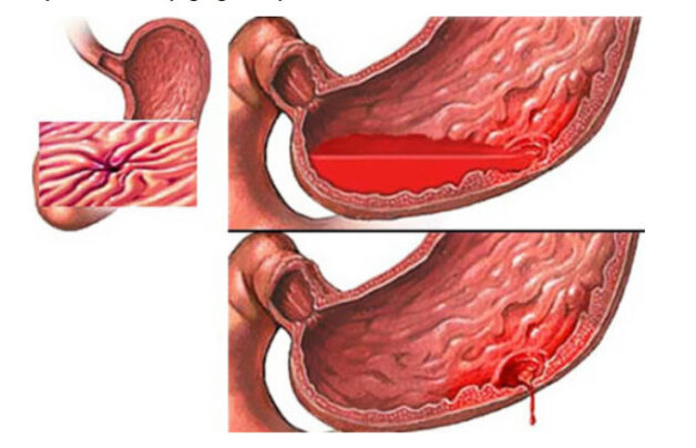 Tìm hiểu về viêm ruột xuất huyết