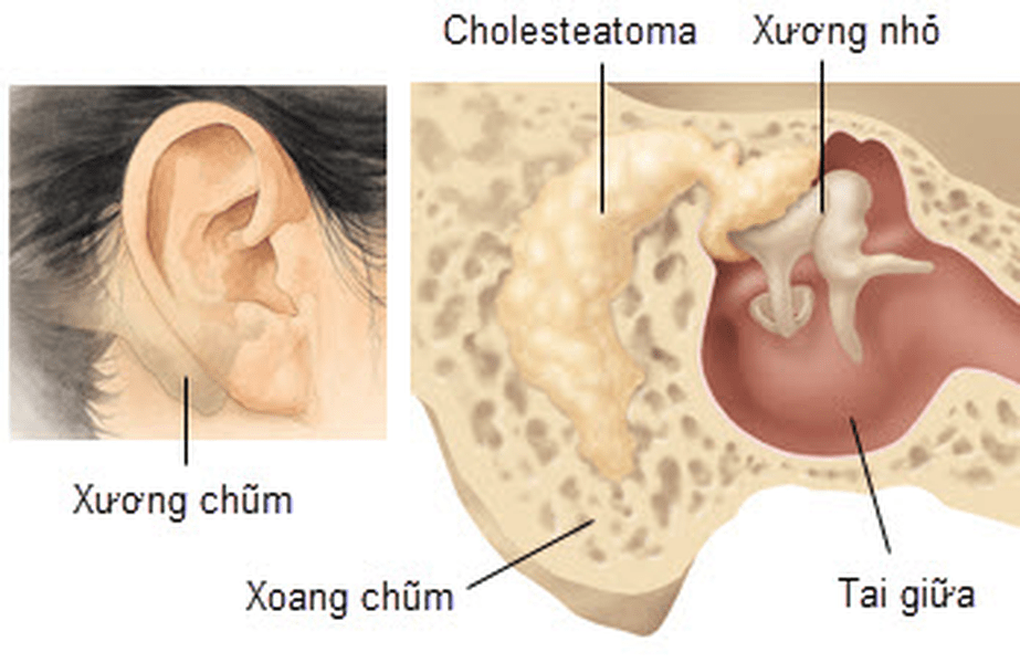 Tìm hiểu về viêm tai xương chũm ở trẻ em