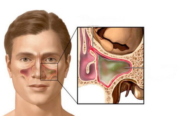 Tìm hiểu về xoang mũi và cách trị xoang mũi