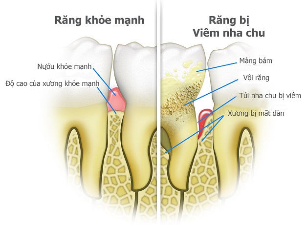 Tìm lời giải đáp cho vấn đề làm sạch cao răng tại nhà