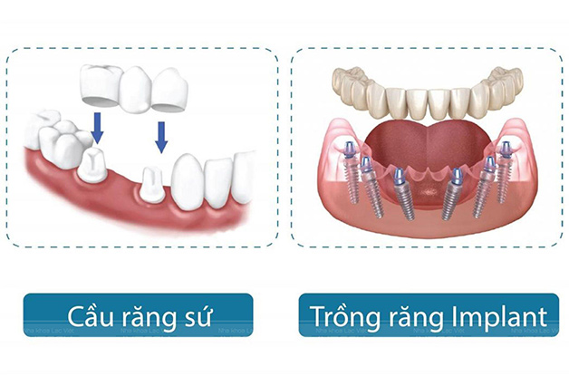 Tìm lời giải đáp thắc mắc: Trồng răng sứ giá bao nhiêu