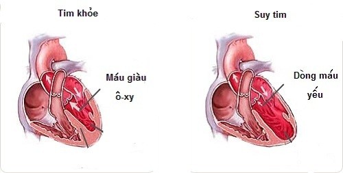 Tim mạch và bệnh cao huyết áp các biến chứng liên quan