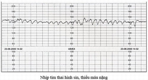 tim thai và cơn co tử cung bằng monitor sản khoa