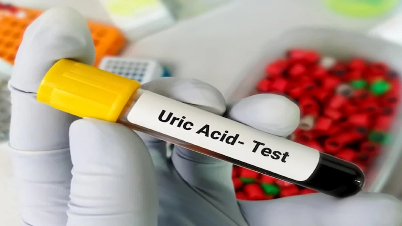 Tình trạng Acid Uric cao và những lưu ý phòng tránh