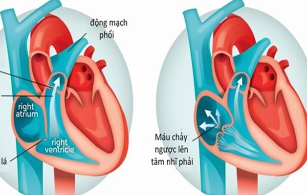 Tình trạng hở van tim ba lá và mức độ nguy hiểm của bệnh