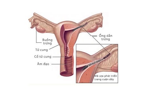 Tình trạng một đoạn ống dẫn bị tắc do ảnh hưởng