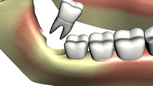 Tình trạng nhổ răng khôn xong có lỗ và những điều cần biết