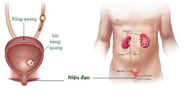 Tình trạng sỏi xuống niệu đạo – những điều cần lưu ý