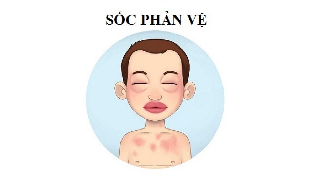 Tình trạng tiêm vắc xin bị sốc phản vệ và cách khắc phục