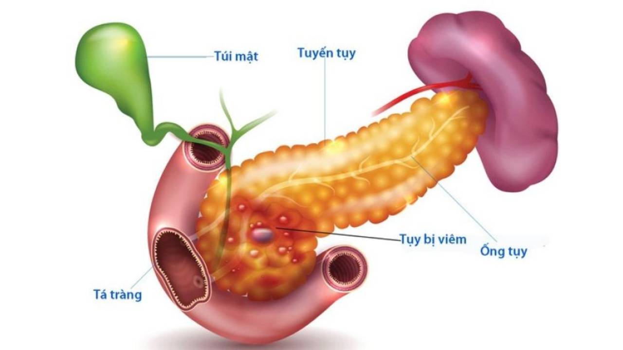 Tình trạng viêm tụy cấp trẻ em và 3 điều cần biết