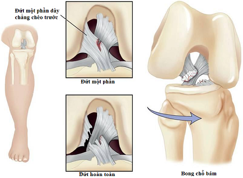 Tổn thương dây chằng chéo khớp gối