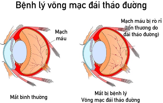 Tổn thương mạch máu ở người mắc bệnh tiểu đường