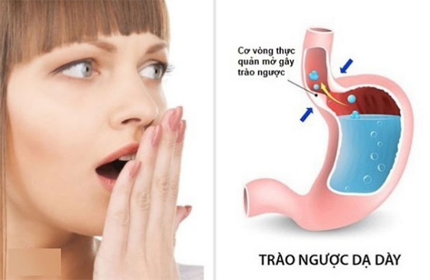 Tổng hợp các nguyên nhân hôi miệng mà bạn cần biết