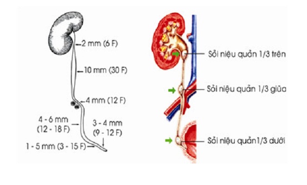 Tổng hợp các phương pháp phẫu thuật nội soi lấy sỏi niệu quản