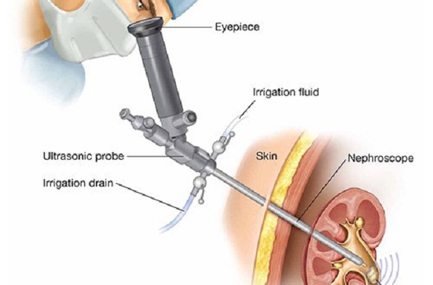 Tổng hợp các phương pháp tán sỏi tiết niệu