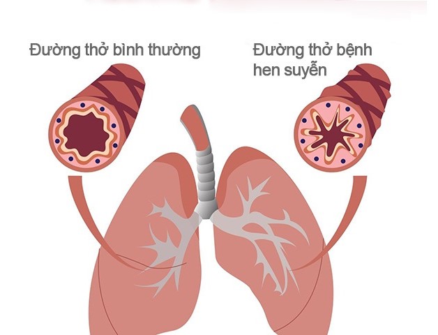 Tổng hợp các thông tin về bệnh hen suyễn