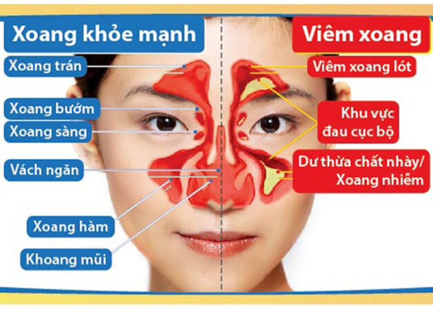 Tổng hợp cách chữa bệnh viêm xoang mãn tính