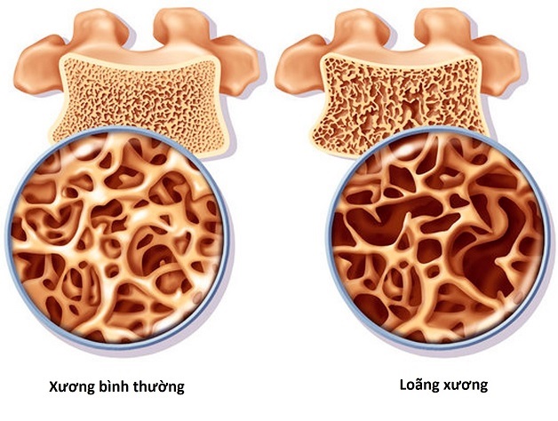 Tổng hợp cách chữa loãng xương hiệu quả hiện nay