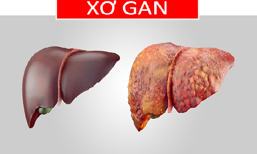 Tổng hợp mọi vấn đề về bệnh xơ gan