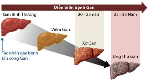 Tổng hợp mọi vấn đề về bệnh xơ gan