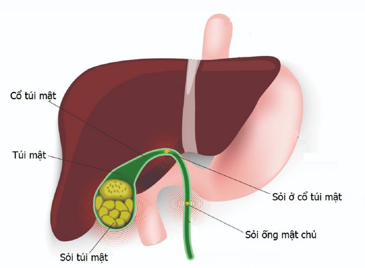 Tổng hợp những phương pháp chữa trị sỏi mật