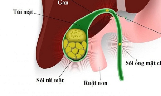 Tổng hợp những phương pháp chữa trị sỏi mật