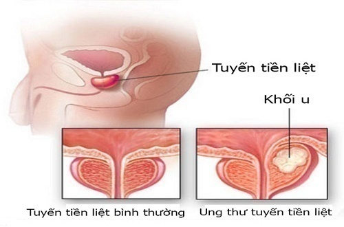 Tổng hợp thông tin cần biết về ung thư tuyến tiền liệt