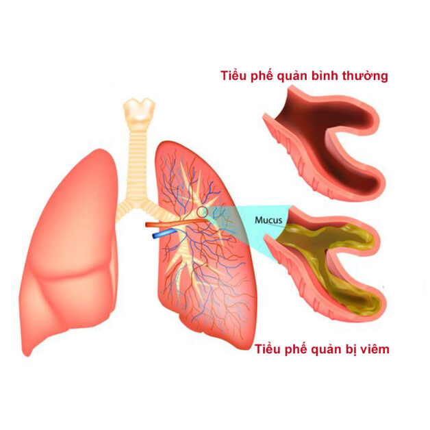 Tổng hợp toàn bộ dấu hiệu viêm tiểu phế quản ở trẻ