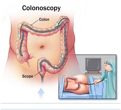 Tổng quan bệnh Crohn