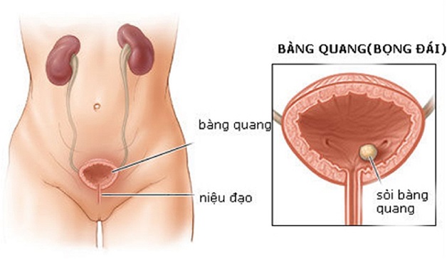 Tổng quan bệnh sỏi bàng quang và cách điều trị