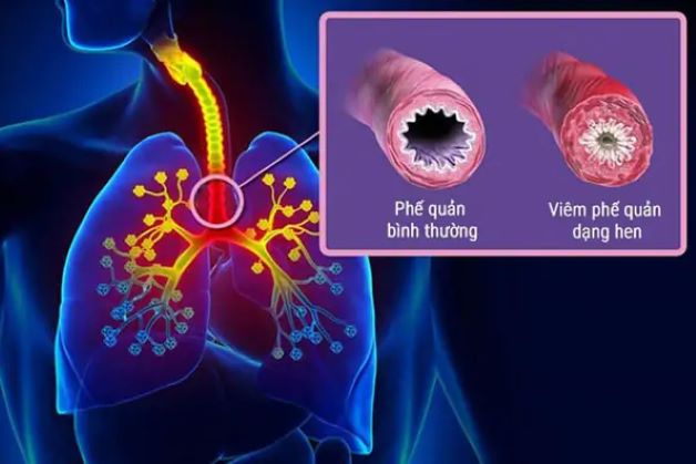 Tổng quan bệnh viêm phế quản dạng hen ở trẻ em