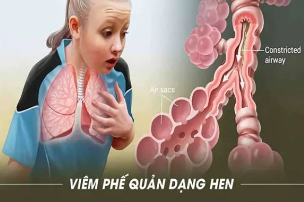 Tổng quan bệnh viêm phế quản dạng hen ở trẻ em