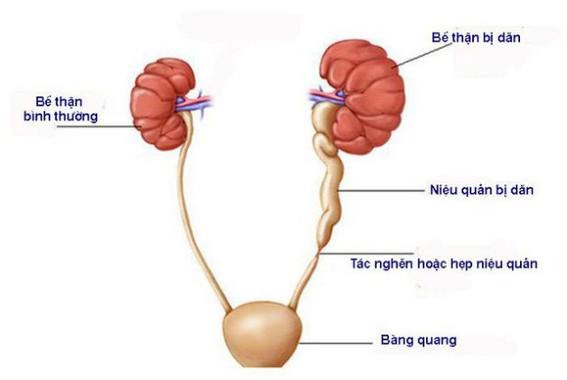 Tổng quan về bệnh hẹp niệu quản