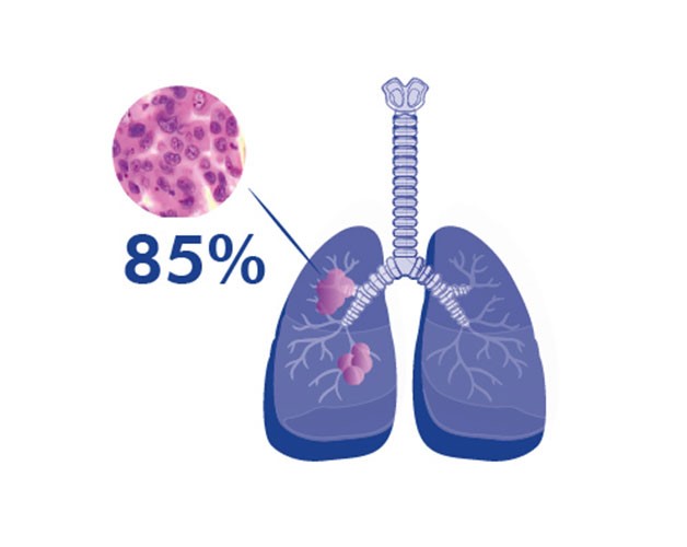 Tổng quan về bệnh ung thư phổi không tế bào nhỏ
