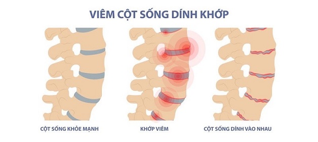 Tổng quan về bệnh viêm cột sống dính khớp