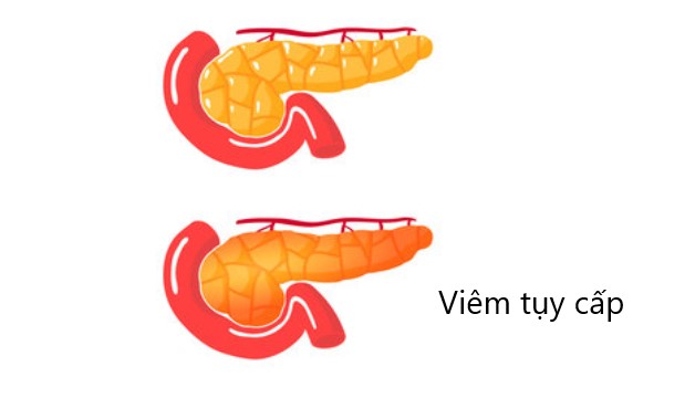 Tổng quan về bệnh viêm tụy cấp