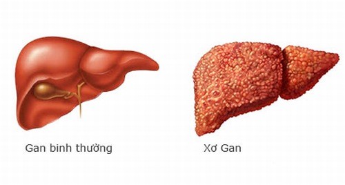 Tổng quan về bệnh xơ gan tổn thương gan nghiêm trọng