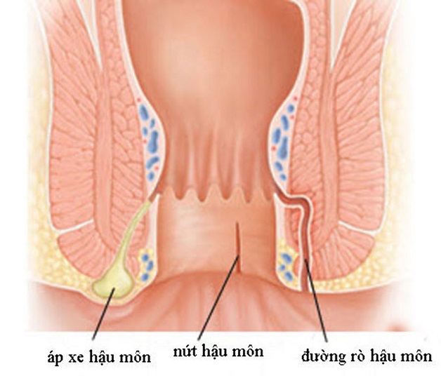 Tổng quan về các bệnh đại trực tràng thường gặp