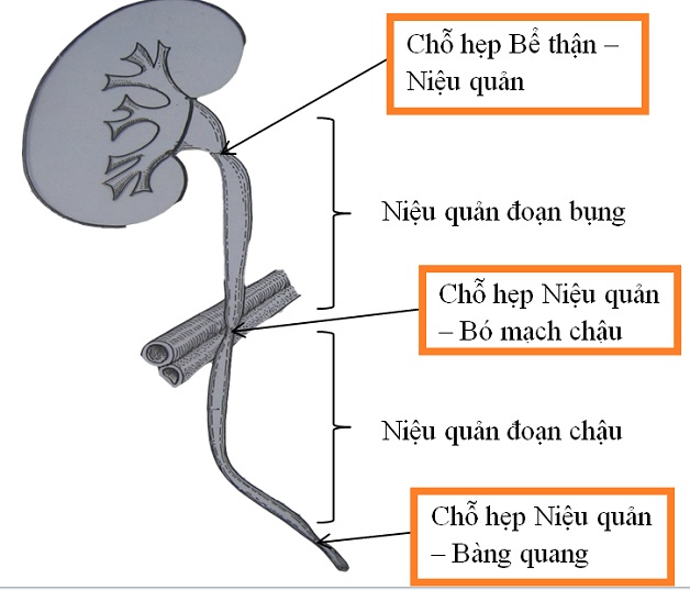 Tổng quan về sỏi niệu quản nội thành bàng quang