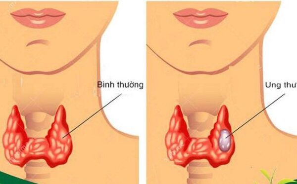 Tổng quan về tầm soát ung thư tuyến giáp ai cũng cần biết