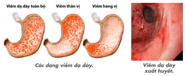 Tổng quan về viêm thân vị dạ dày