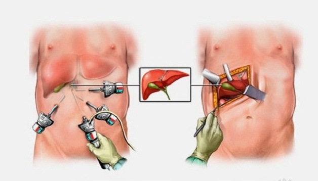 Top 5 tiêu chí lựa chọn điều trị sỏi mật ở đâu tốt nhất