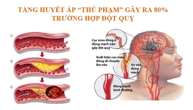 Top 6 nguyên nhân gây tai biến mạch máu não