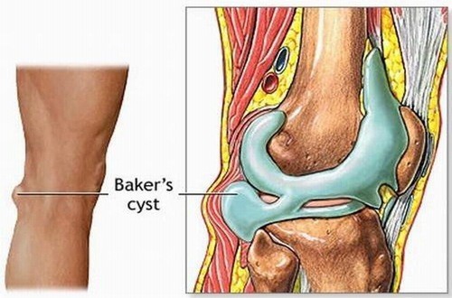 Tràn dịch khớp gối là gì?Nguyên nhân gây tràn dịch khớp gối